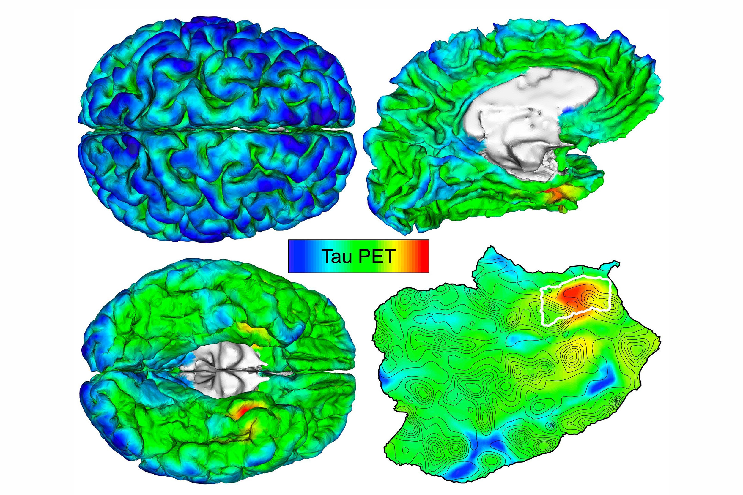 Brain PET sanc