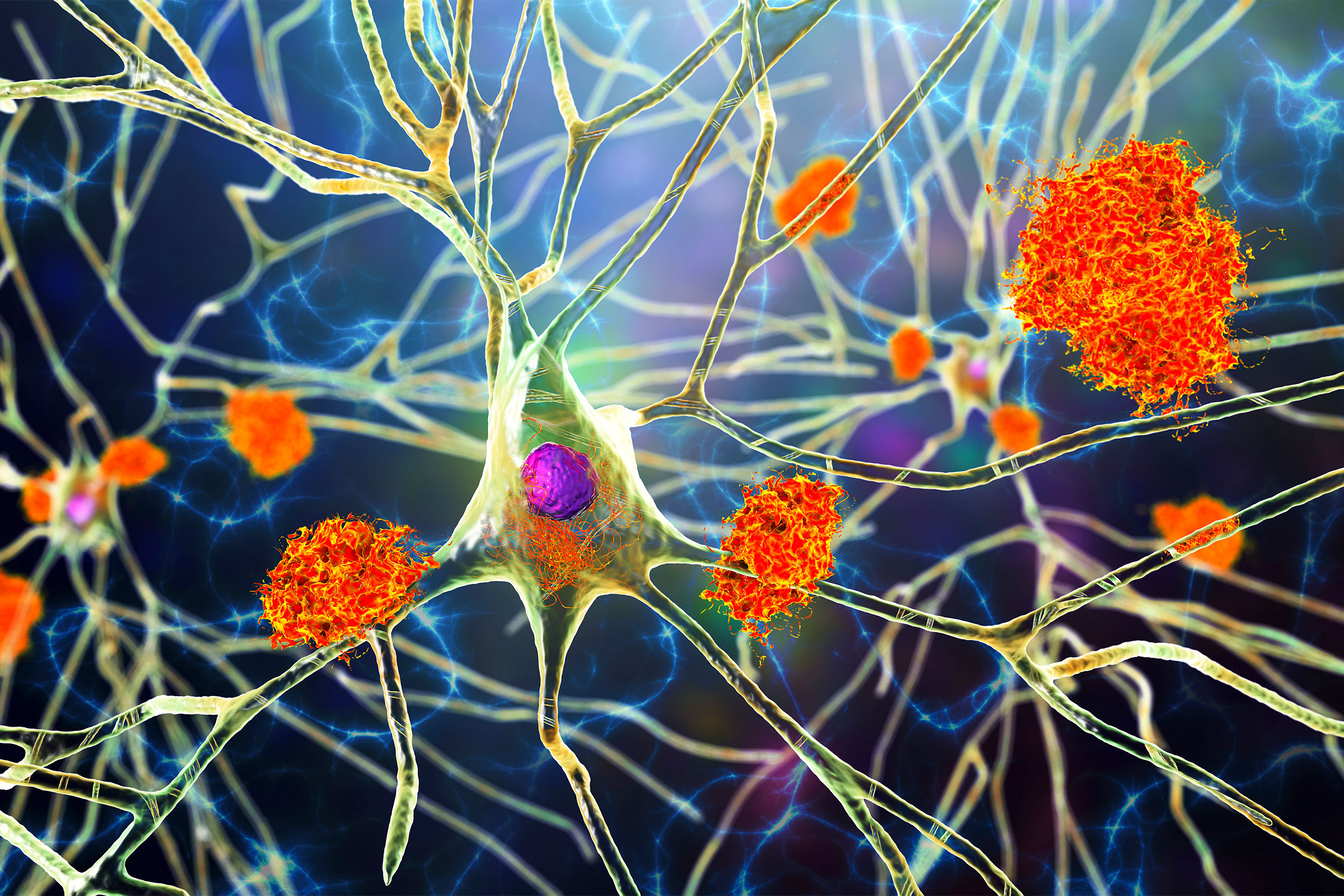 Neurons in Alzheimer's disease. 3D illustration