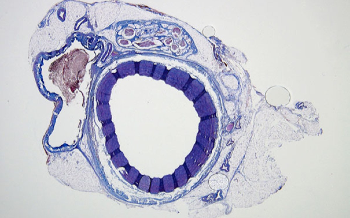 Histological staining of an untreated vessel where blood can freely flow (image 1) and a vessel (image 2) that was successfully filled and embolized with the shear-thinning biomaterial (STB). Over time, the STB was degraded and replaced by natural tissue in with only remnants of the STB (indicated by asterisks). Credit: Wyss Institute at Harvard University