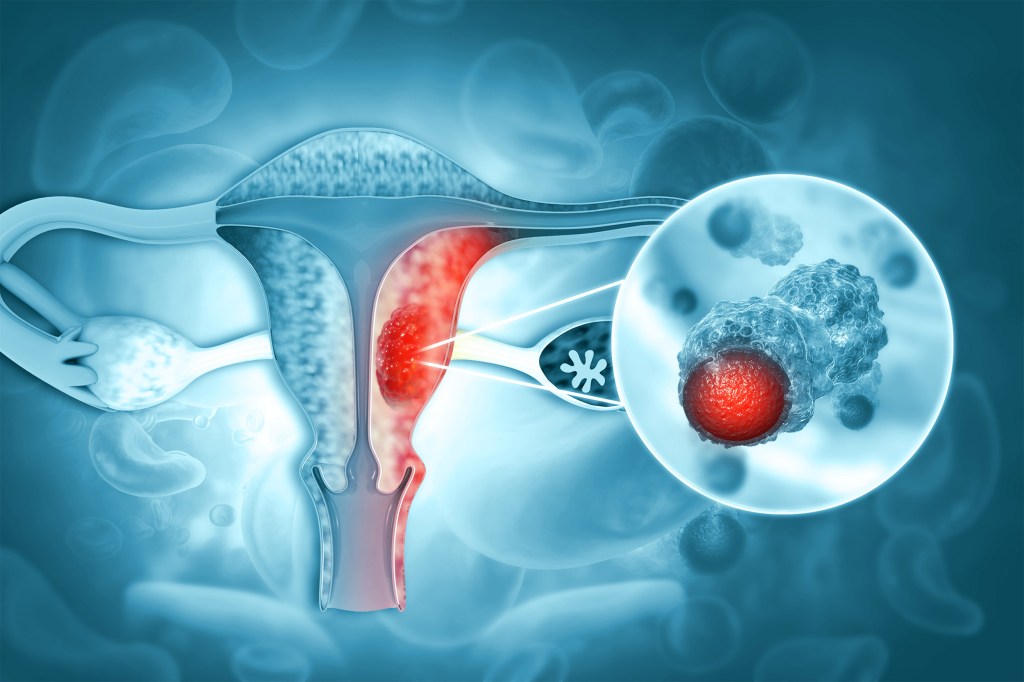 Female reproductive system diseases.uterus cancer and endometrial malignant tumor as a uterine medical concept.3d illustration