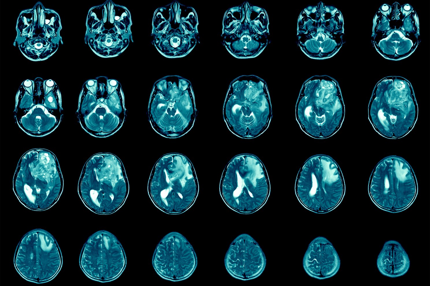 MRI showing glioblastoma.