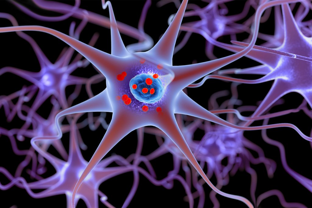 Illustration shows neurons containing deposits of alpha-synuclein (indicated with small red spheres) that have accumulated in the brain cells.