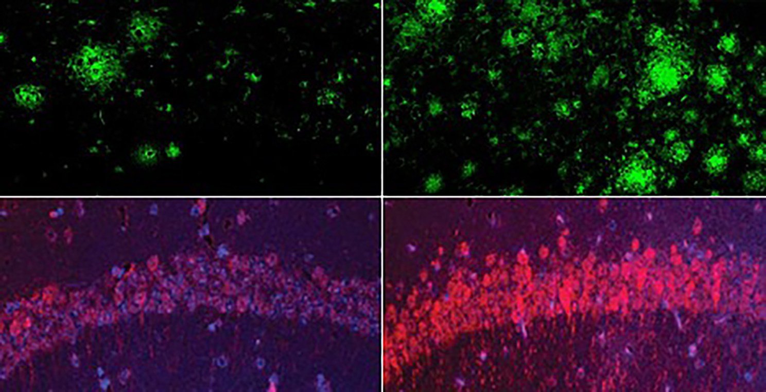 One pair of boxes shows fewer green amyloid clusters on the left and more on the right. Another pair of boxes shows a dim arc of purple and red tau on the left and a brighter arc on the right.