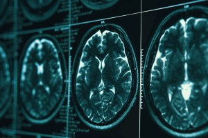 brain scnas